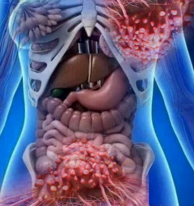 Ung thư chẳng có gì đáng sợ